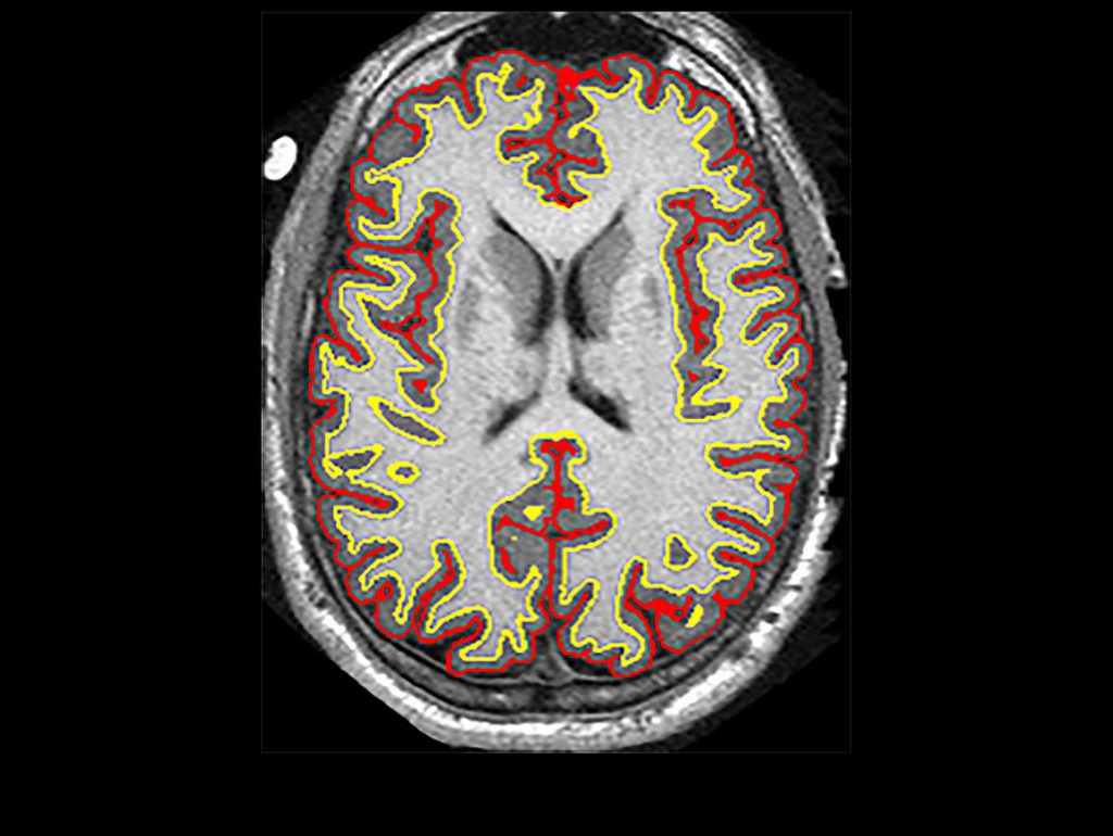 brain scan image