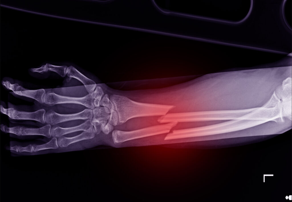 x-ray showing forearm fracture