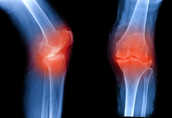 x-ray of knee representing osteoarthritis